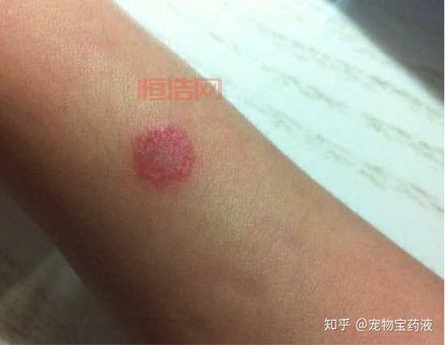 人得了猫癣不治疗会自己好吗？别侥幸，这有答案！