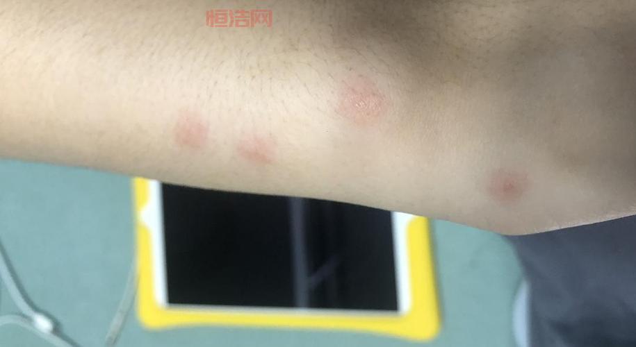 人得了猫癣不治疗会自己好吗？别侥幸，这有答案！