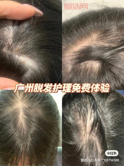 TOUFEI的原因与解决方法：脱发护理全指南