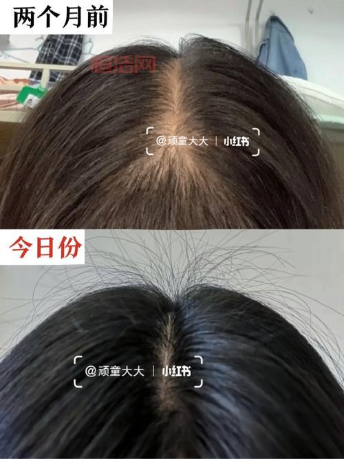 TOUFEI的原因与解决方法：脱发护理全指南